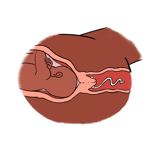 An illustration showing a cross-section of a baby inside the womb, a cervix, a vagina, and a prostaglandin pessary placed at the posterior part of the cervix inside the vagina.