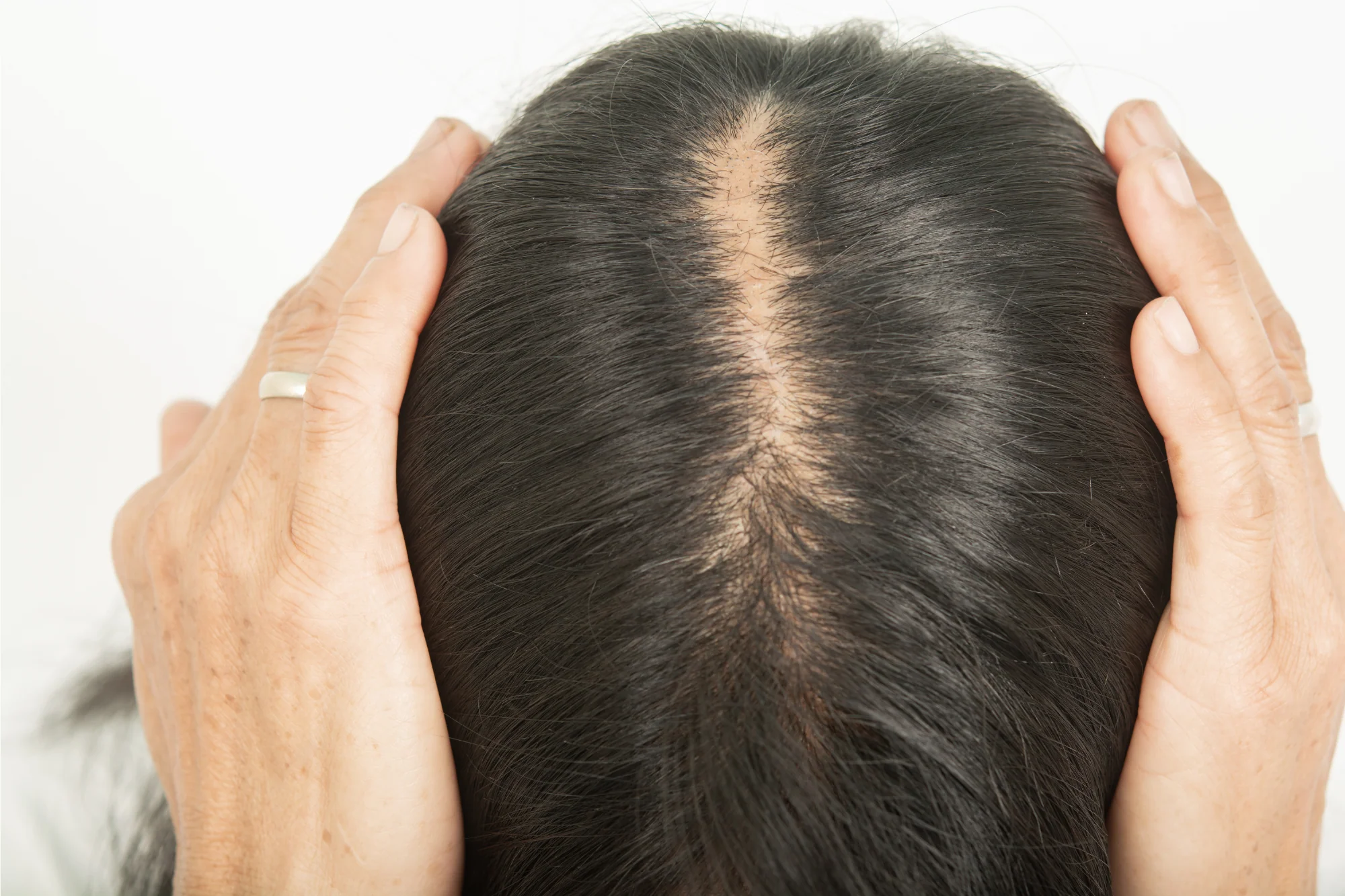 woman with hairloss - Does Semaglutide Cause Hair Loss