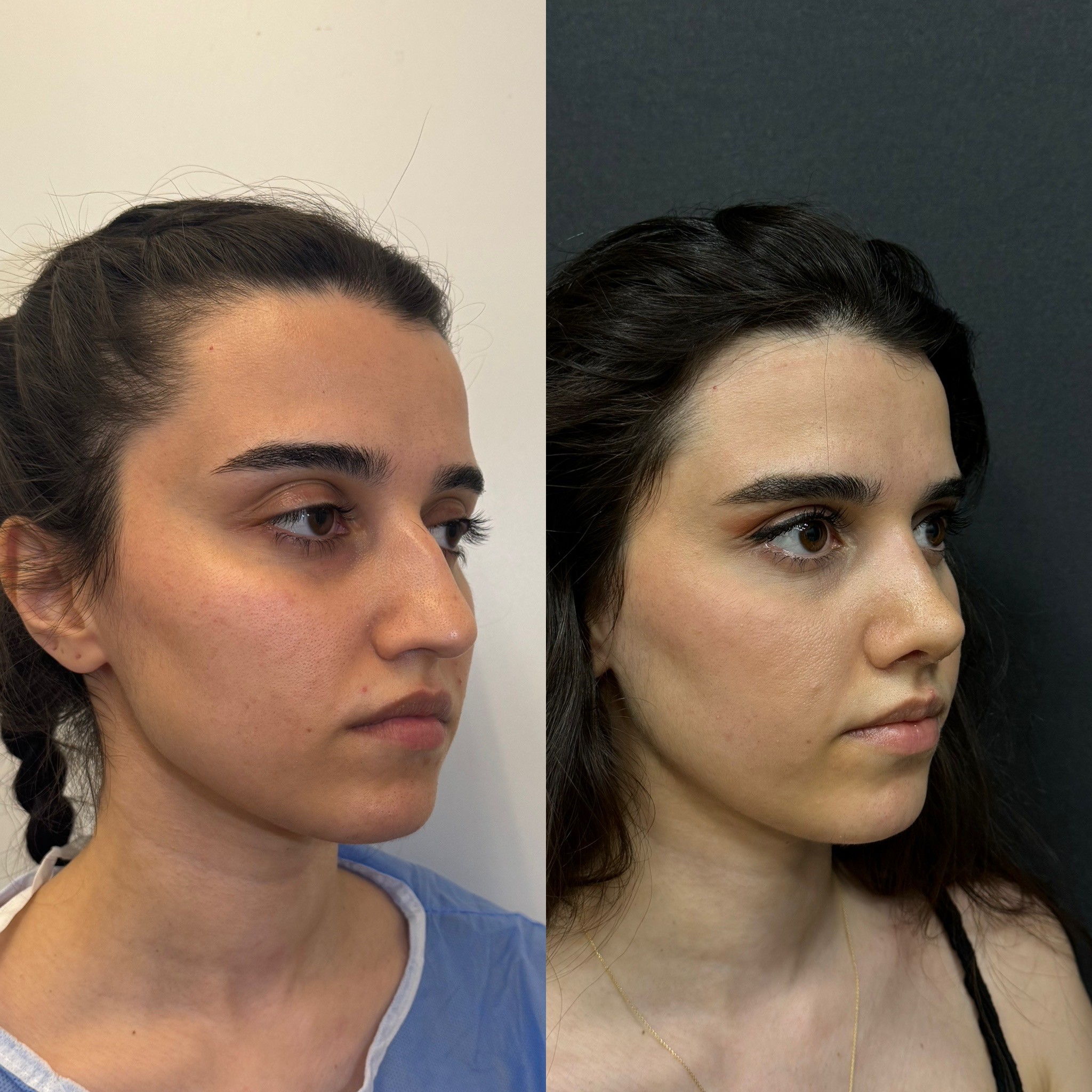 20 days post-op before after rhinoplasty patient oblique view