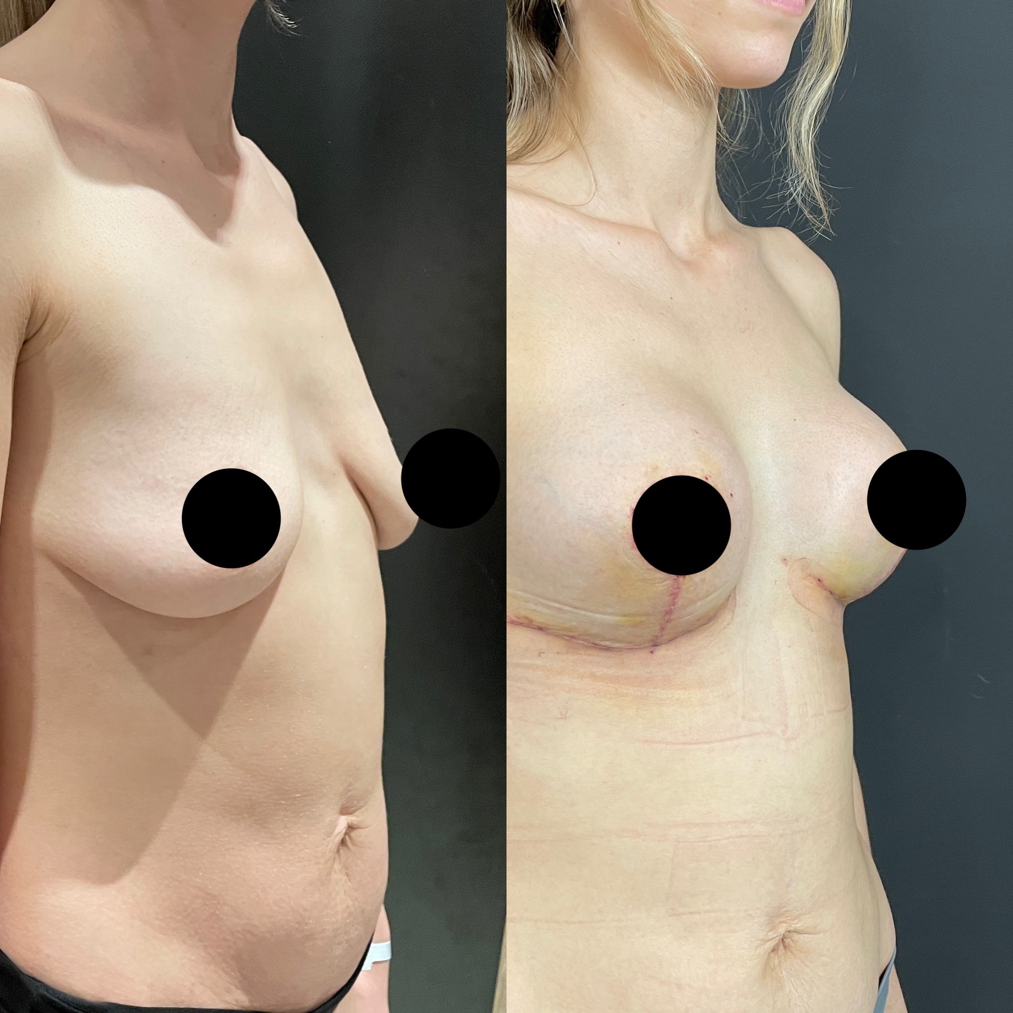 6th day before after breast lift with implant oblique view