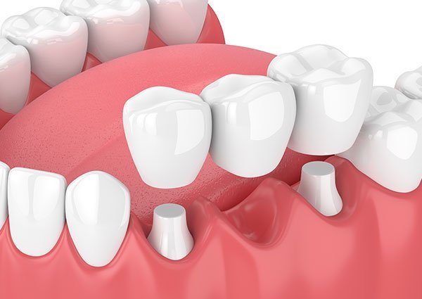 dental crown and bridges service