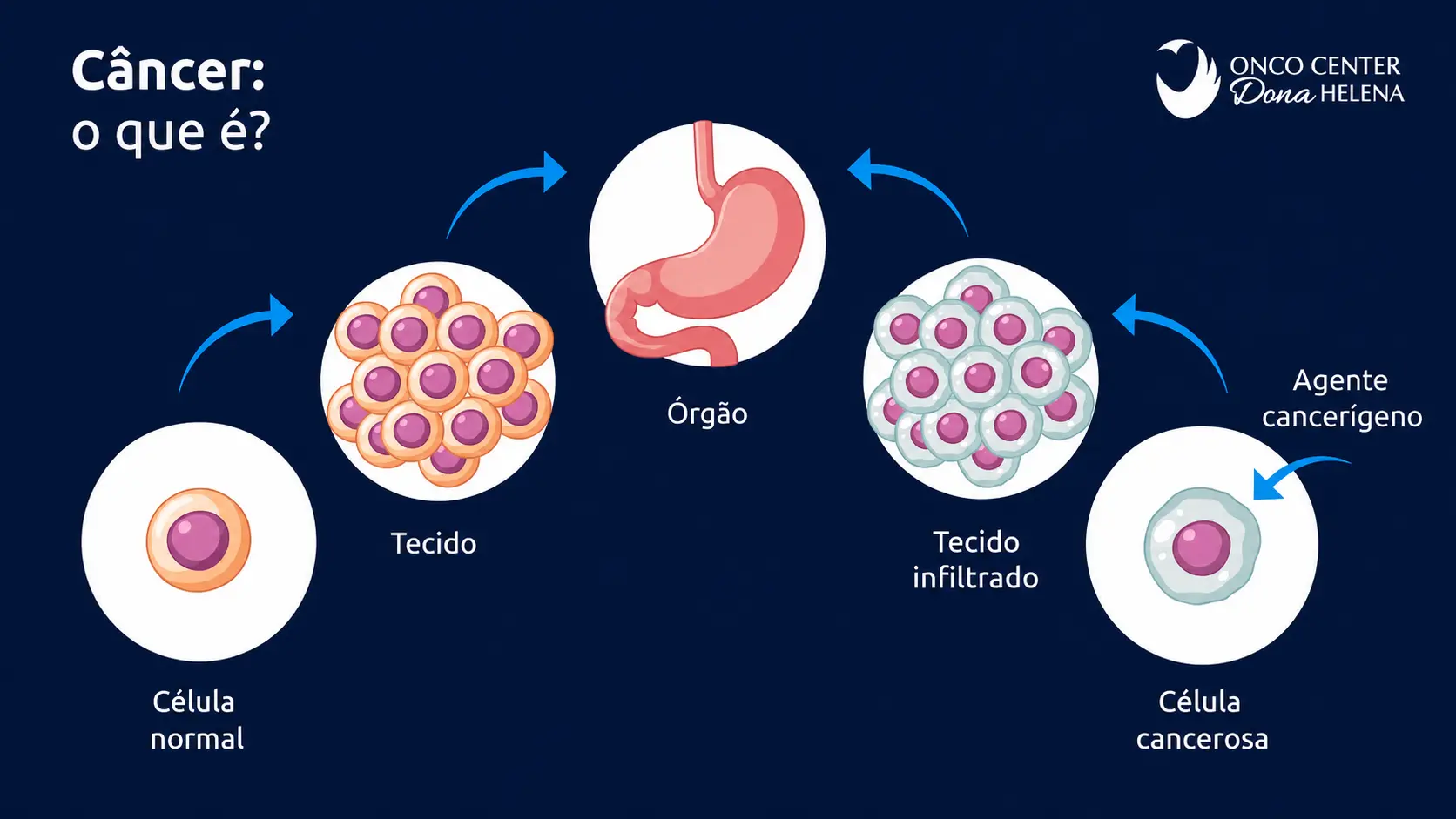 Ilustração explicativa sobre o que é câncer, mostrando a progressão de uma célula normal para uma célula cancerosa. A imagem inclui as etapas: célula normal, tecido, órgão, tecido infiltrado, e célula cancerosa. Também destaca a presença de um agente cancerígeno.
