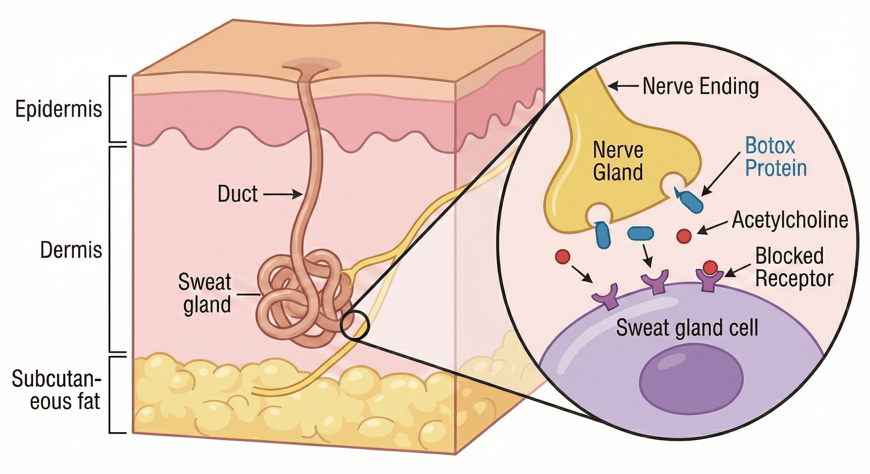 A medical illustration showing the cross-section of the skin, highlighting the sweat gland and the nerve ending where the Botox protein acts to block the chemical messenger (acetylcholine).