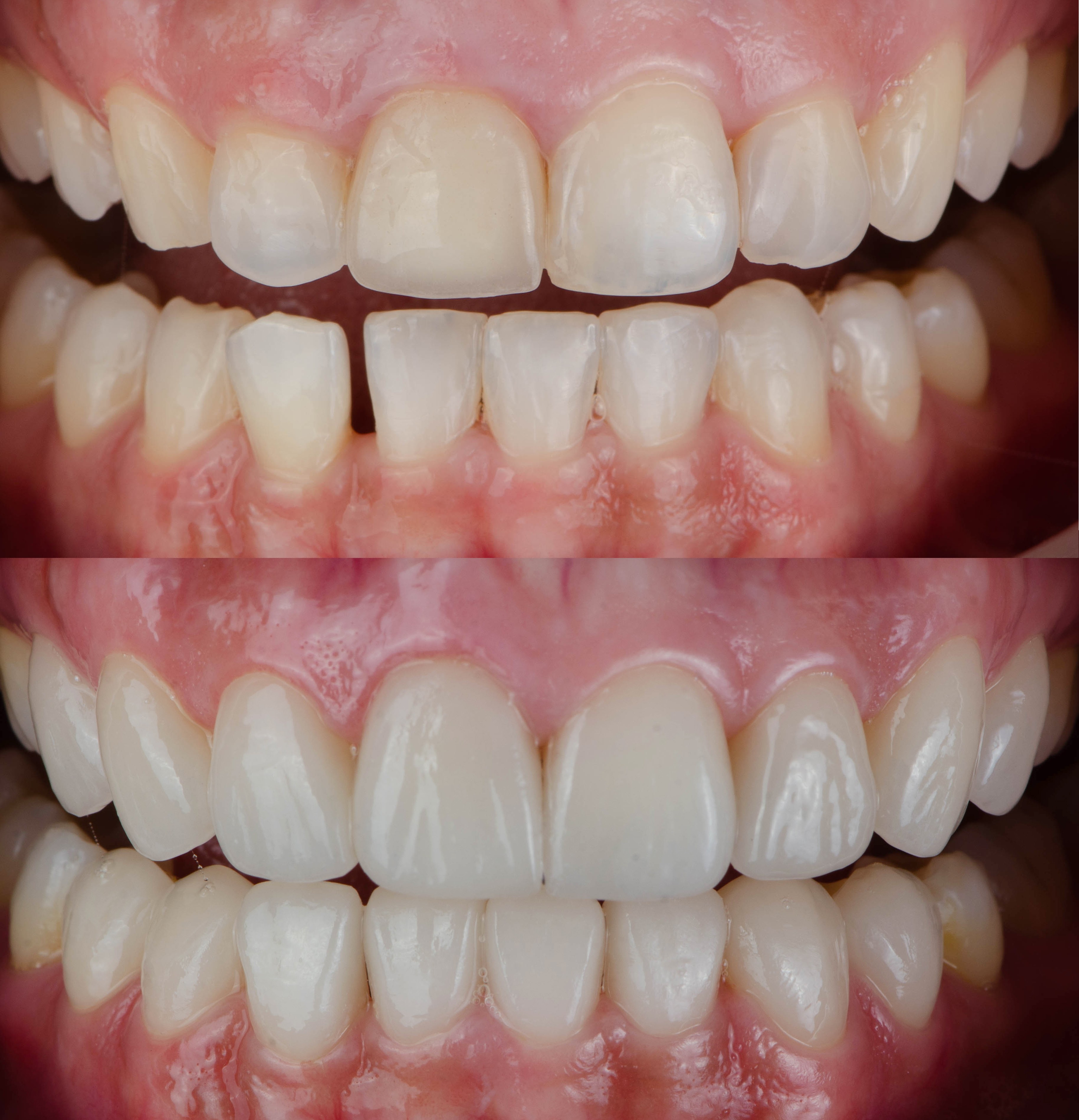 how a smile was transformed with porcelain veneers at the Invisalign Center in Dubai by Dr Fida, cosmetic dentist