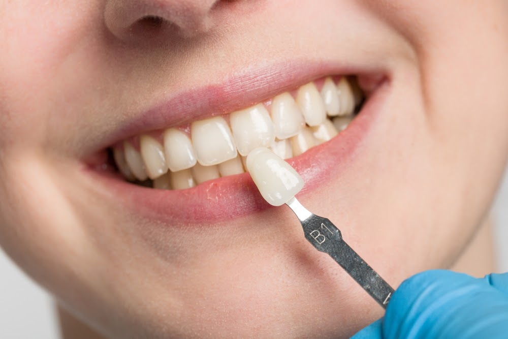 discover the 5 steps leading upto your veneers treatment