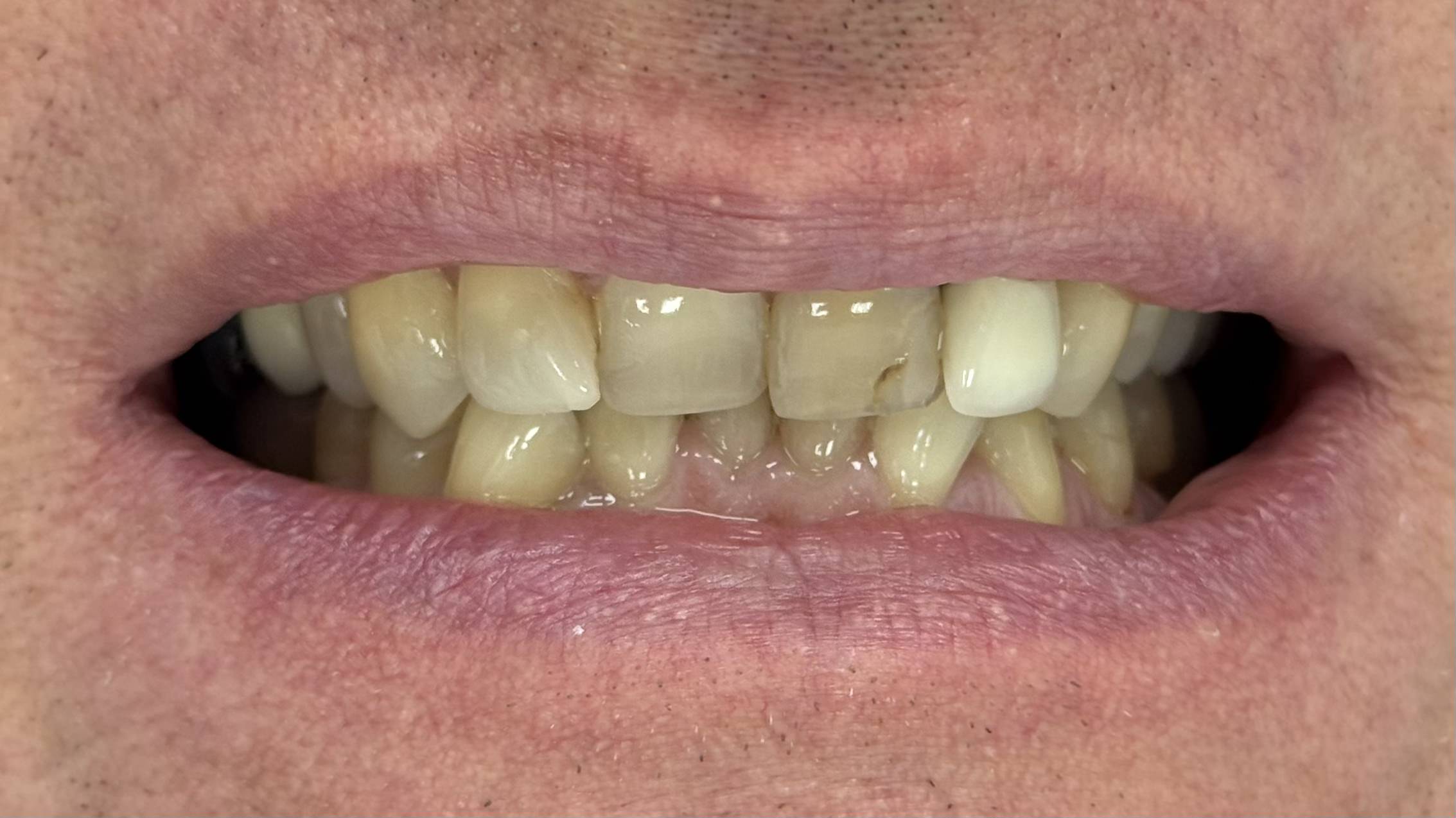 Crowns, Full smile redesign - before treatment