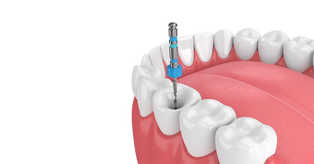 Root canal treatment on tooth