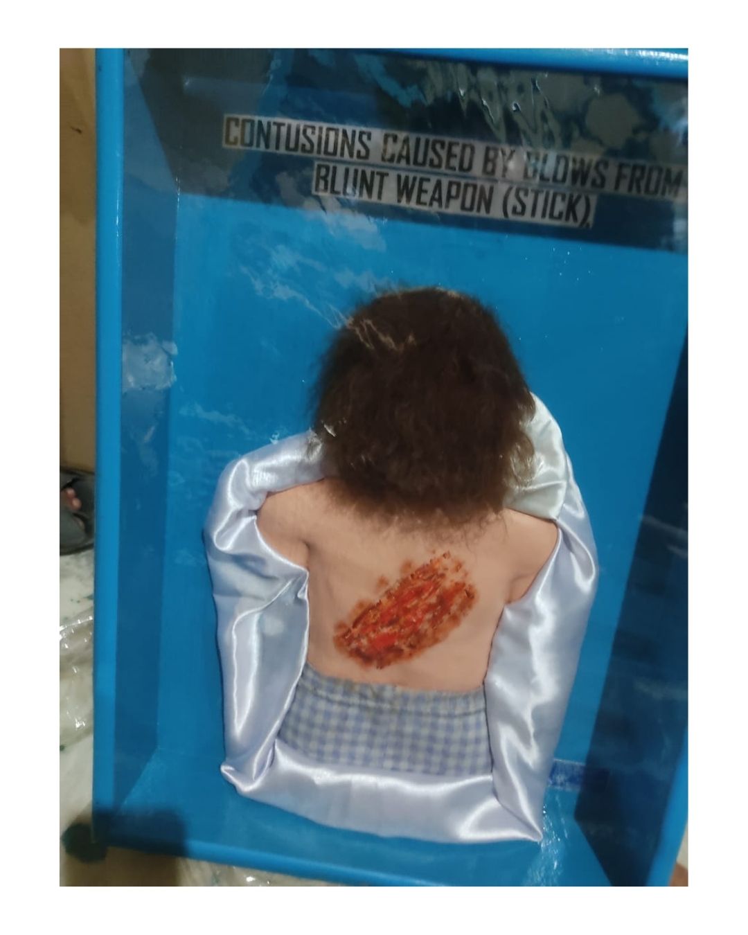 Contusions Caused by Blows from Blunt Weapon (Stick)