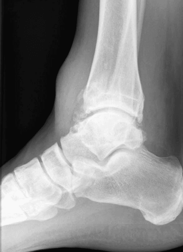 X-ray of Lower Extremity Ganglion Cysts