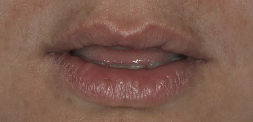 Before ortho treatment