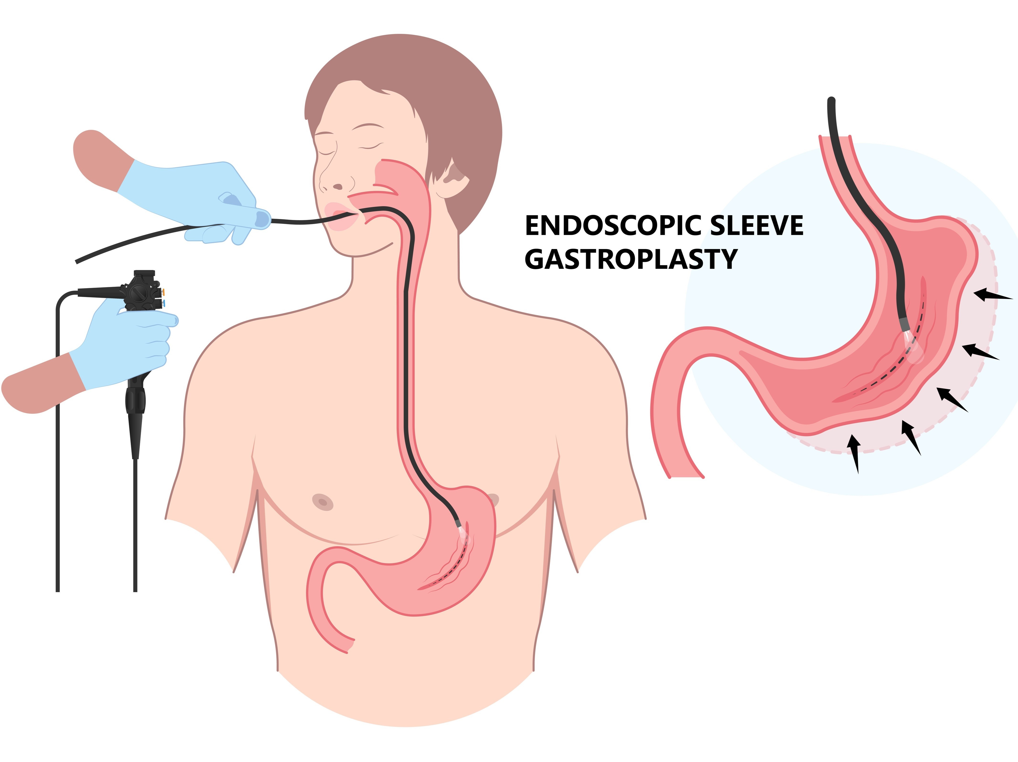 weight loss surgeries