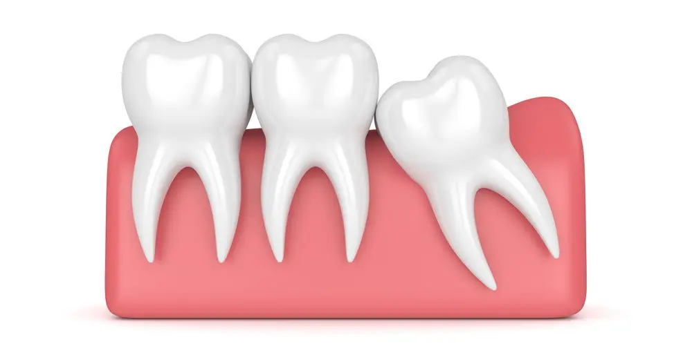 Dentes do Siso: Tudo o que precisa de saber