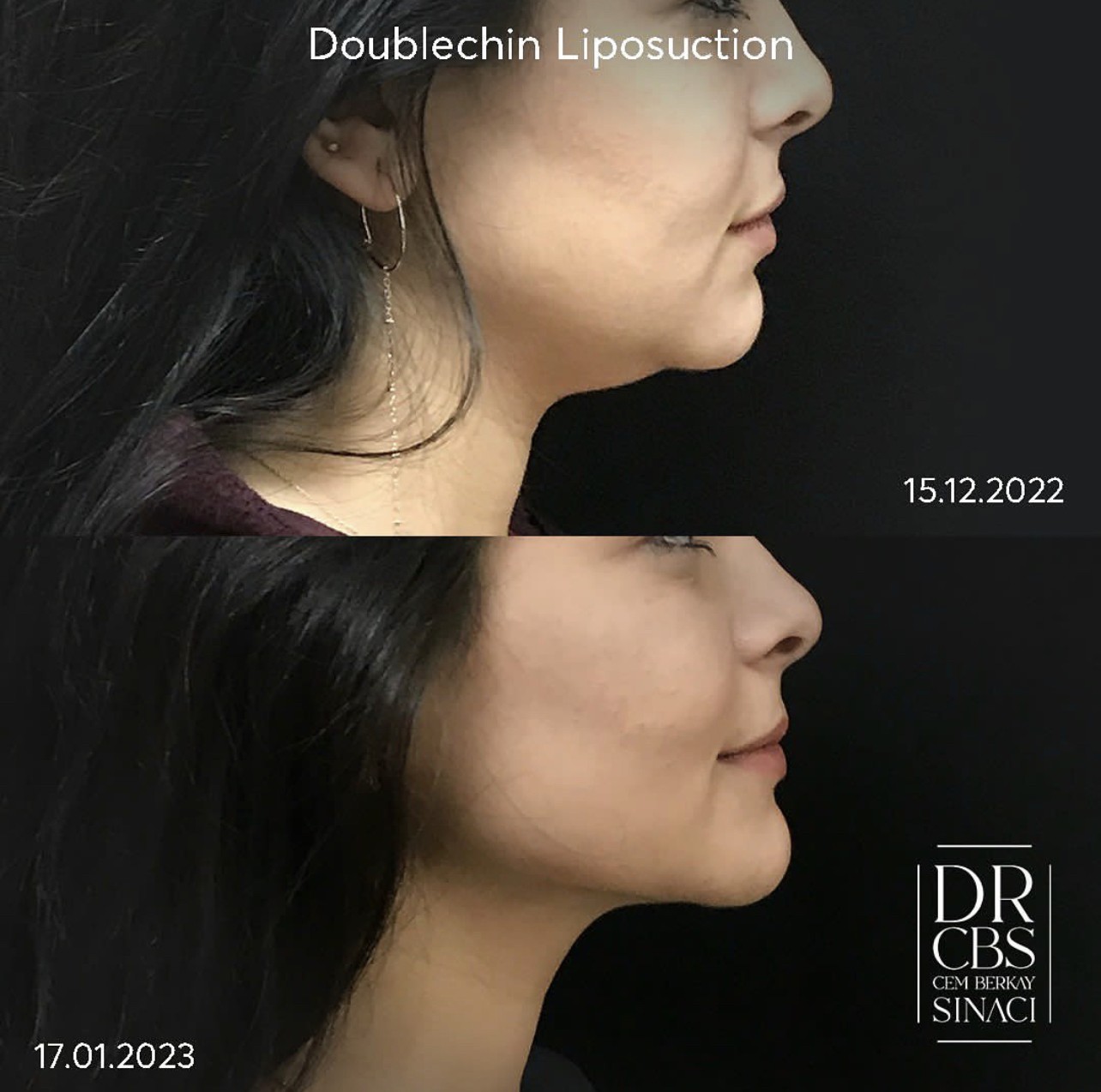 2 weeks double chin liposuction before after side view