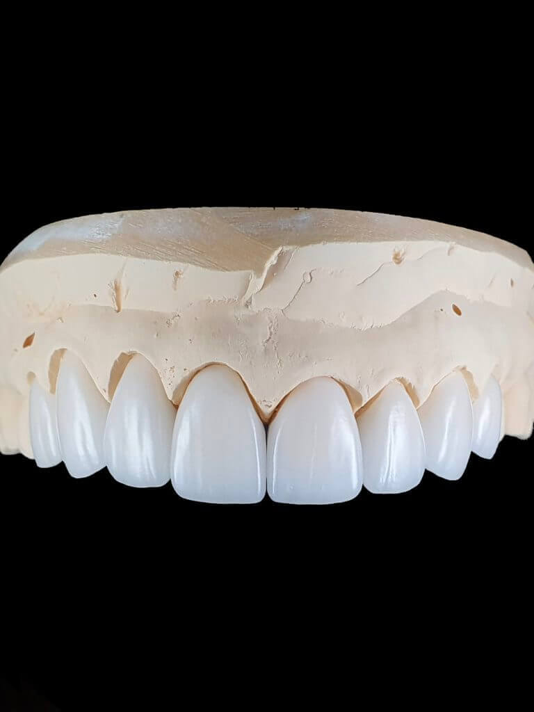 porcelain veneers