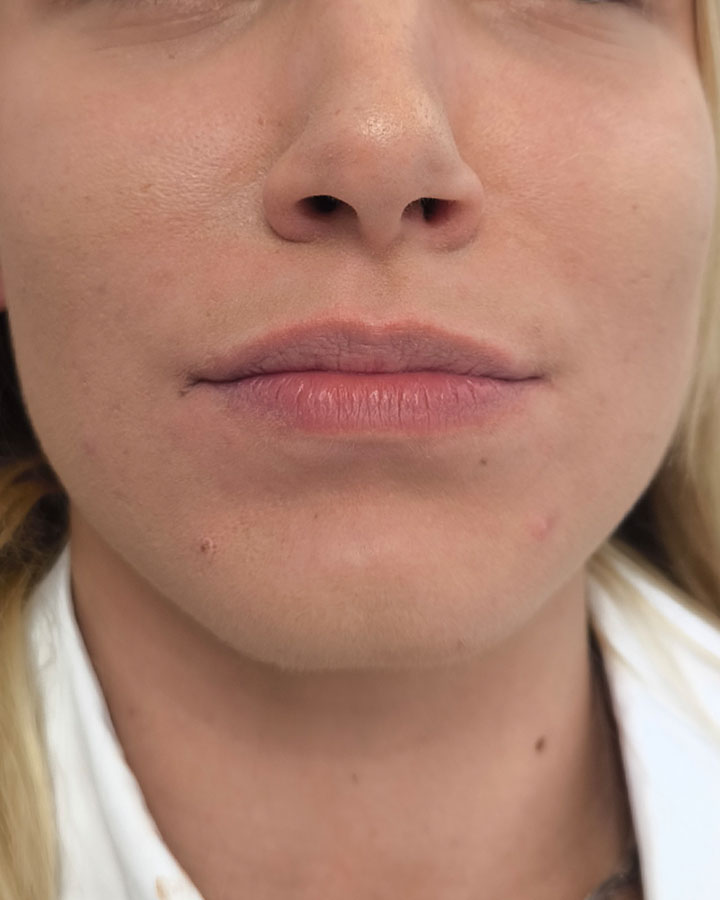 Prirodzený vzhľad pier pred zväčšením objemu kyselinou hyalurónovou