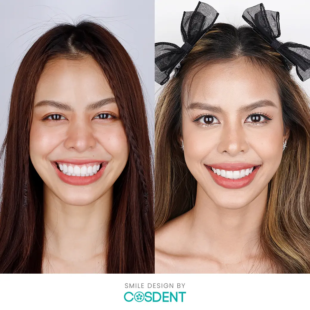 คุณ น้ำเพรช befor and after ออกแบบรอยยิ้มวีเนียร์ cosdent smile design