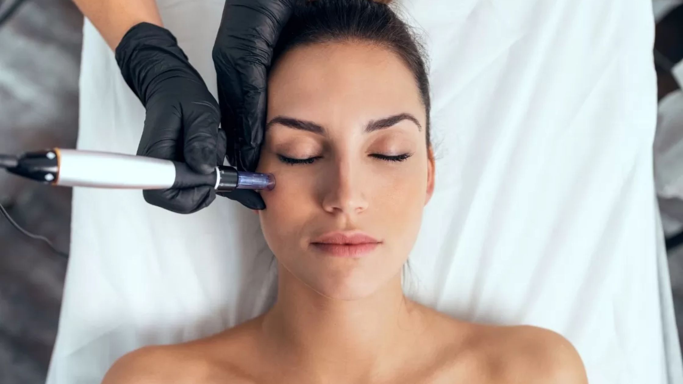 Ultimate Guide to Microneedling in Frisco