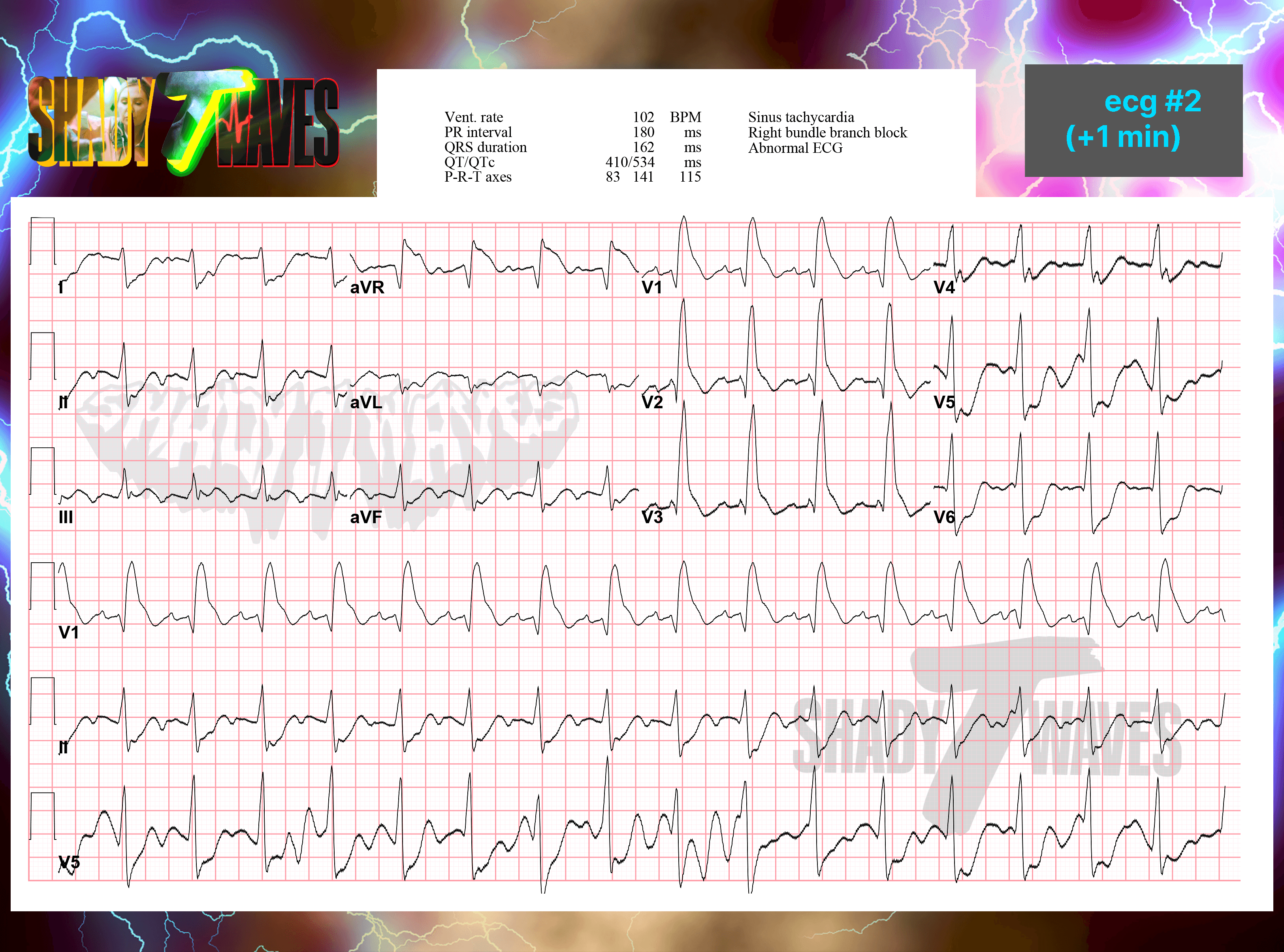 ED ECG #2