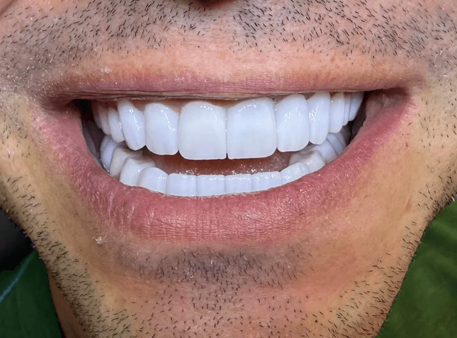 After treatment