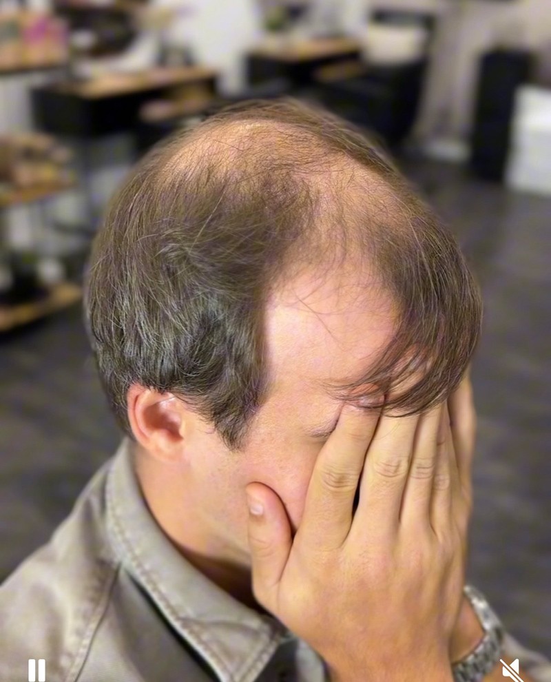 Cortese Haarsysteme - Vorher-Ansicht 3