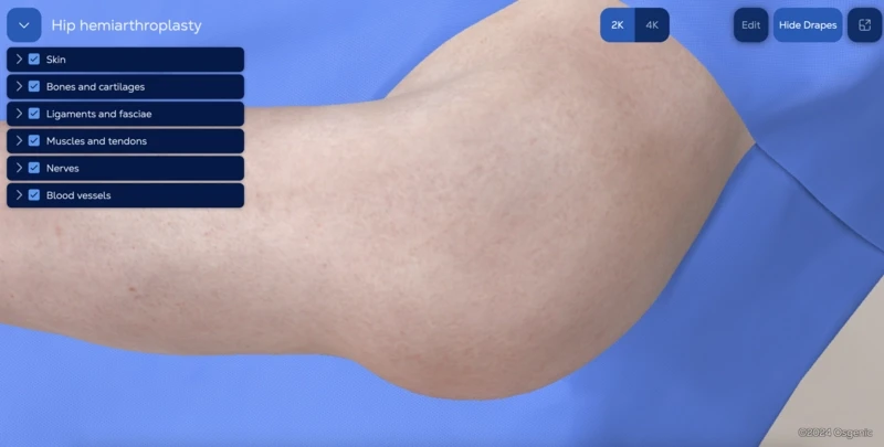 Hip hemiarthroplasty - posterior approach