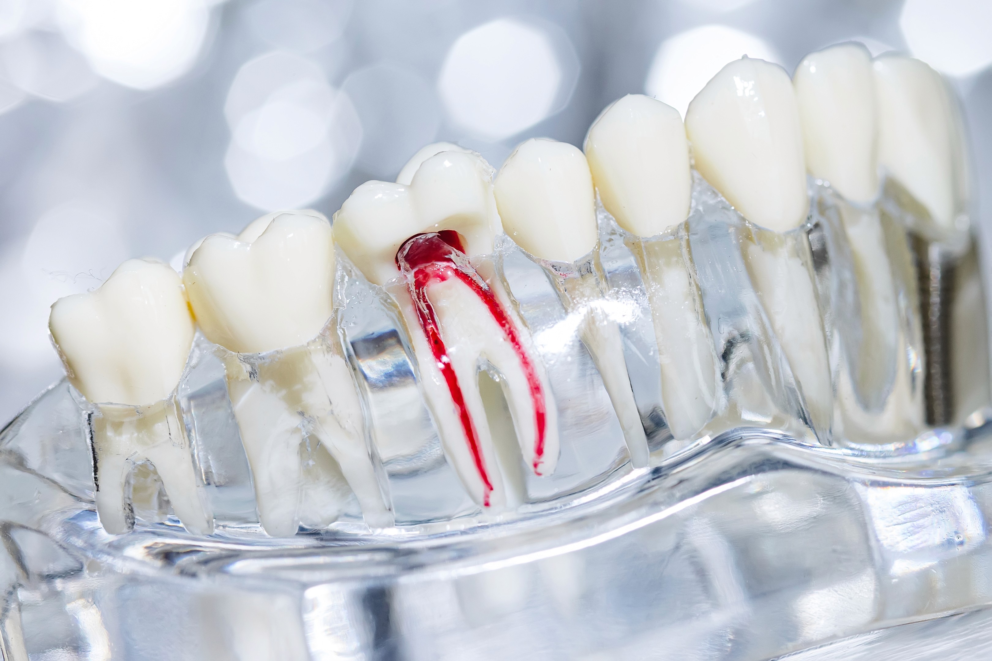 Root canal fees vary by tooth type, number of canals, and the complexity of treatment required.