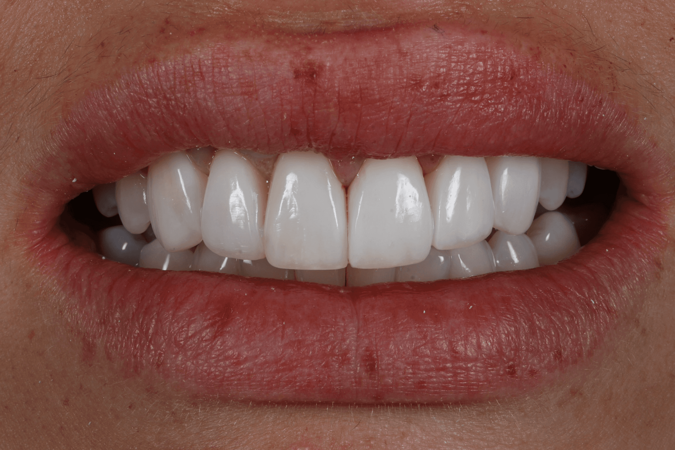 Clear Aligners + Composite Bonding, Smile redesign, Full mouth rehabilitation - after treatment
