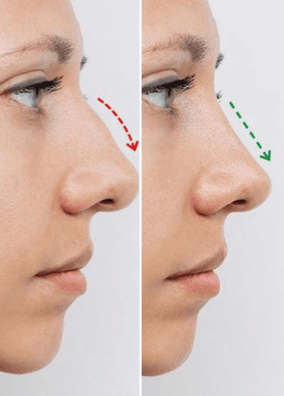 Nose Reshaping