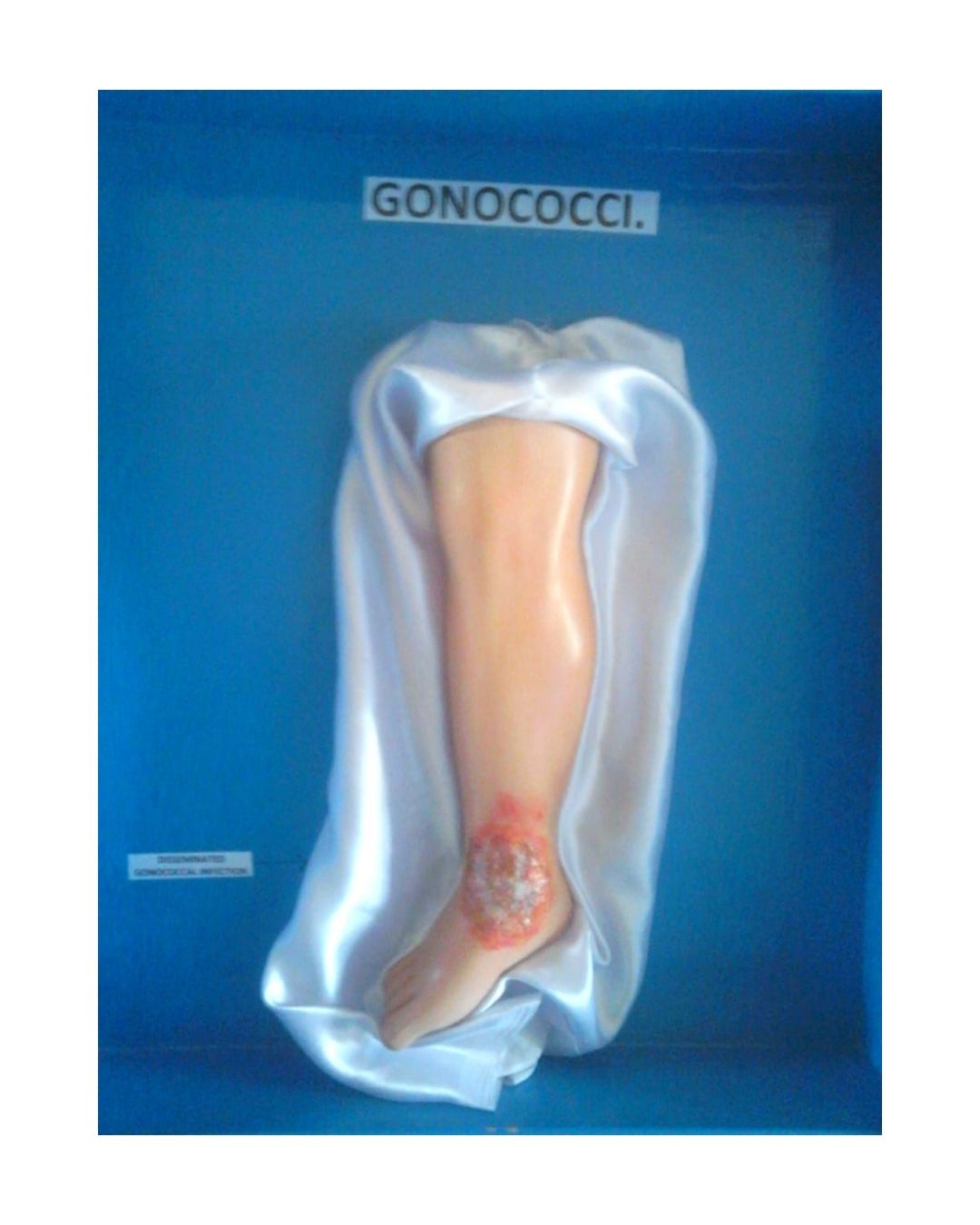 Gonococci – Discharging Gonococcal Infection (Leg Model)