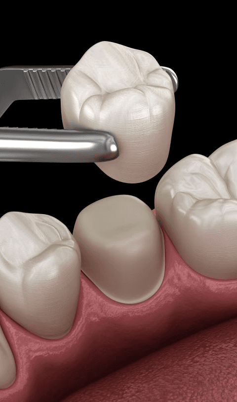 Same-Day Dental Crown Paramus