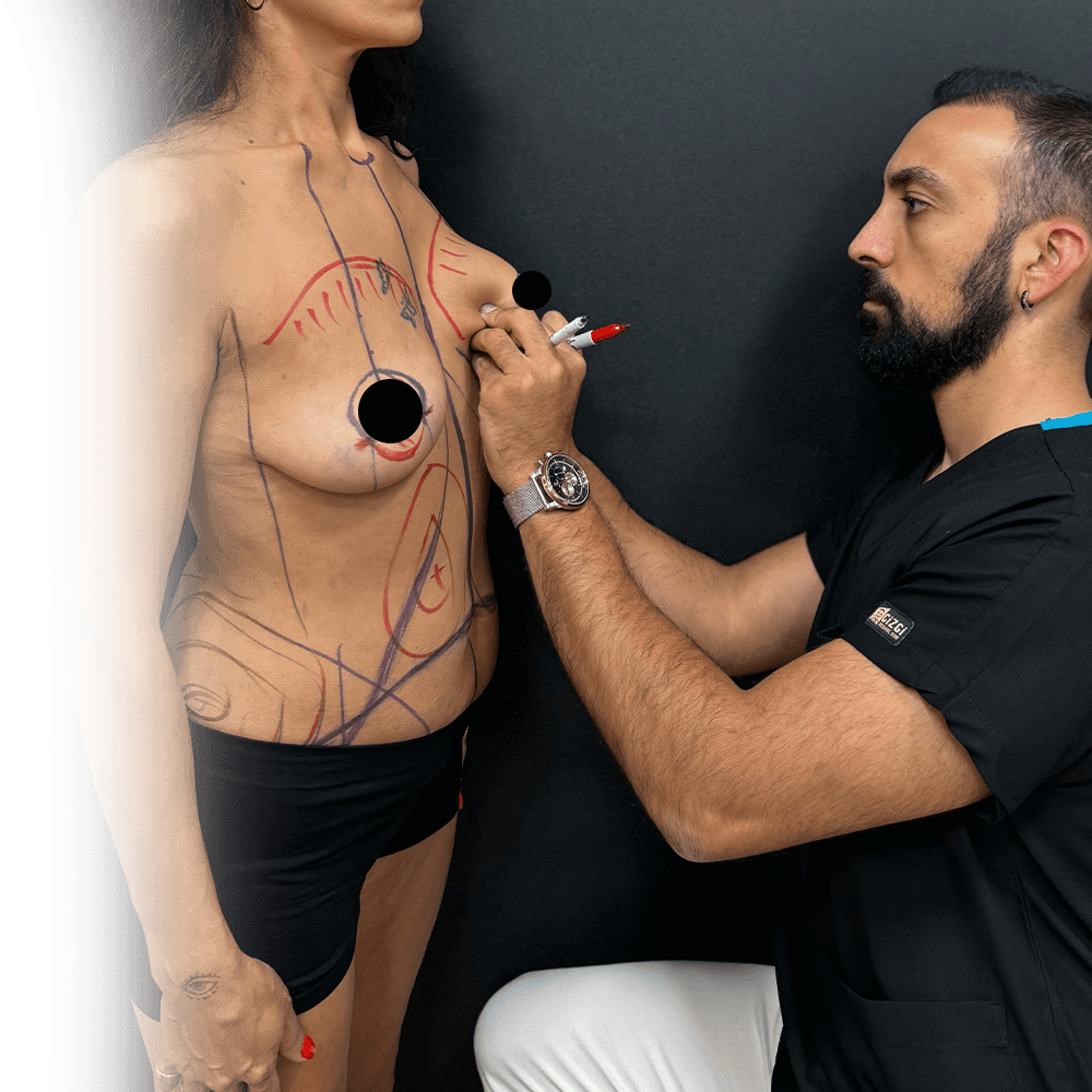 Dr. CBS marking breast lift patient before surgery