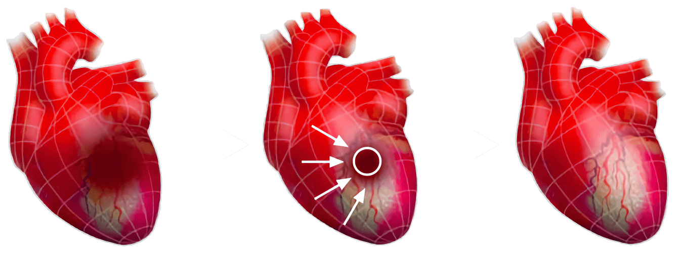 Illustration of a heart showing progression from a blocked artery to improved blood flow, symbolizing non-surgical treatments for heart disease at Sibia Medical Centre. Explore non-surgical treatments for heart disease at Sibia Medical Centre. This illustration shows the improvement of blood flow in a blocked heart, emphasizing non-invasive solutions for managing heart disease effectively.