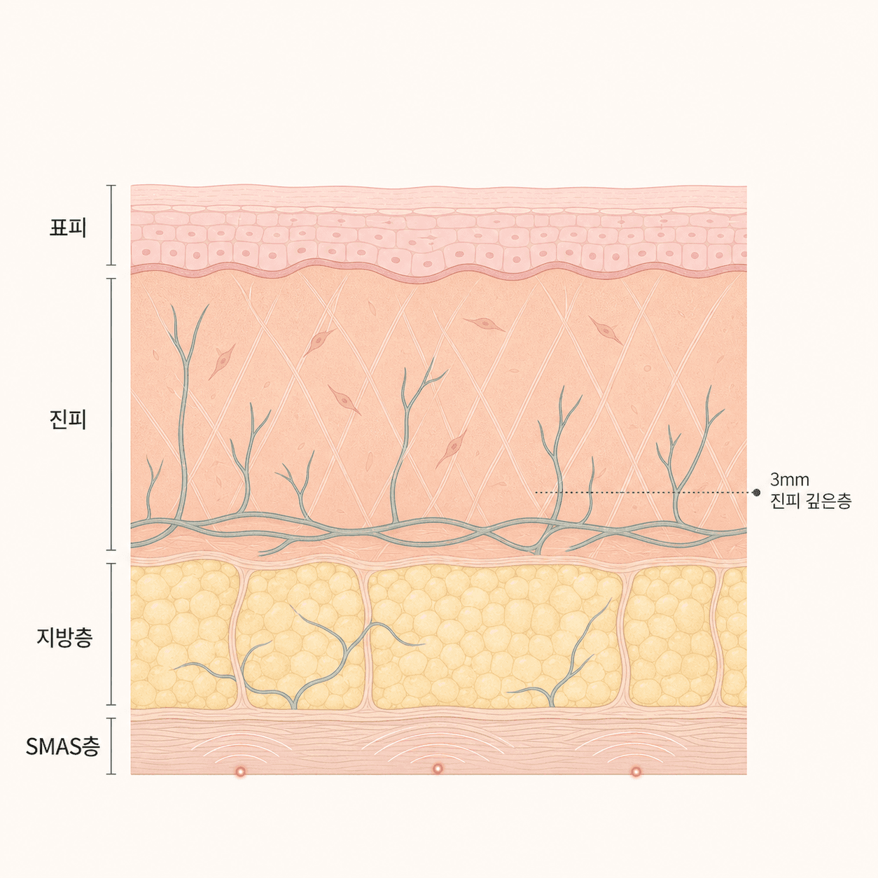 초음파가 겨냥하는 진피와 깊은 SMAS층