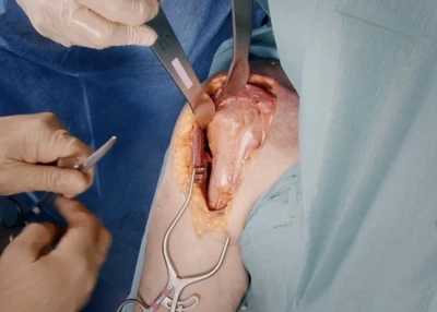 Deltopectoral approach