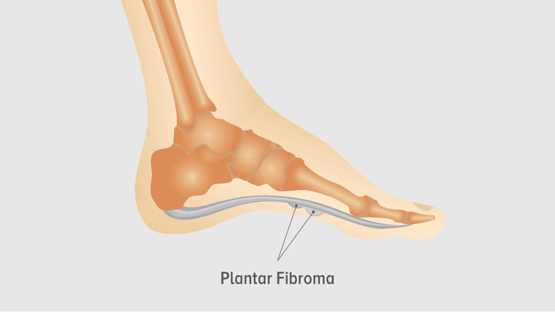 illustration of fibromatosis