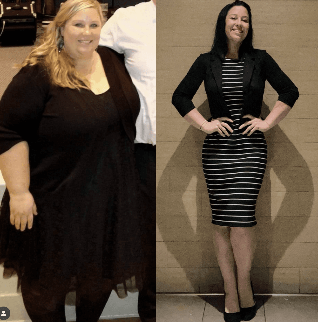 Before and after of surgery image