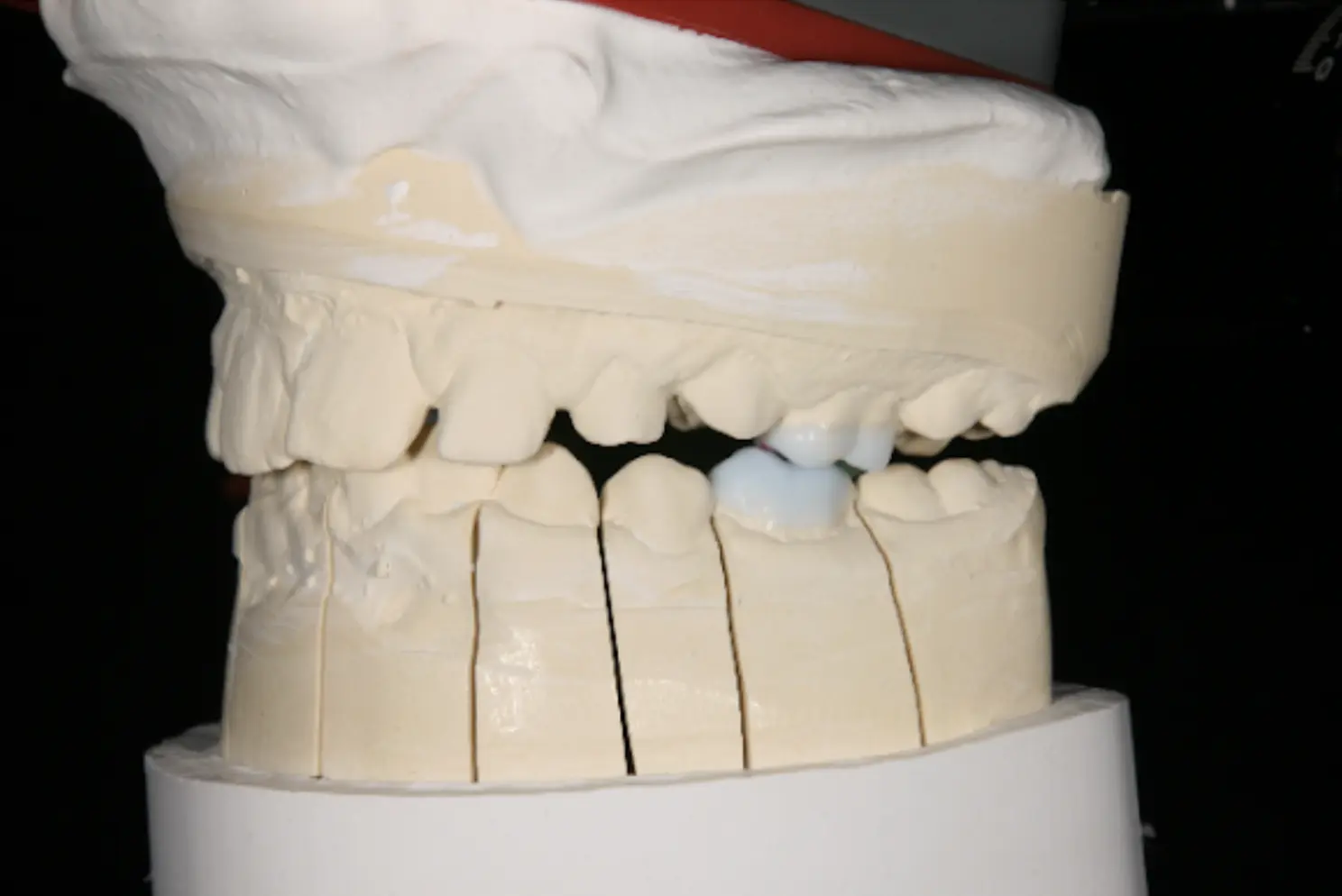 Wax-up-Entwurf der zukünftigen Onlays mit einem speziellen Mechanismus, der den Unterkiefer in eine  grundlegend bessere physiologische Position bringt. Dieser Ansatz entlastet die Kiefergelenke (TMJs)  und fördert ein gesundes Wachstum der Kiefer sowie der Gesichts- und Schädelknochen.
