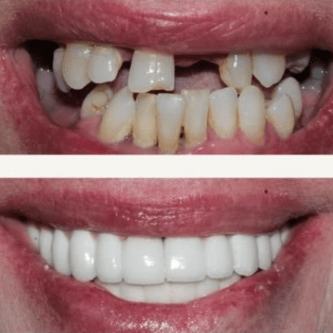 Before and After Dental Crown Treatment at ScarboroSmiles Dental Clinic in Scarborough, ON | Best dentist in Scarborough.
