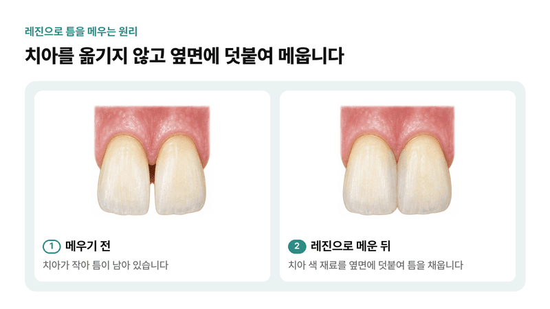 작은 앞니 사이 틈을 치아 색 레진으로 옆면에 덧붙여 메우는 원리를 메우기 전과 뒤로 비교한 일러스트