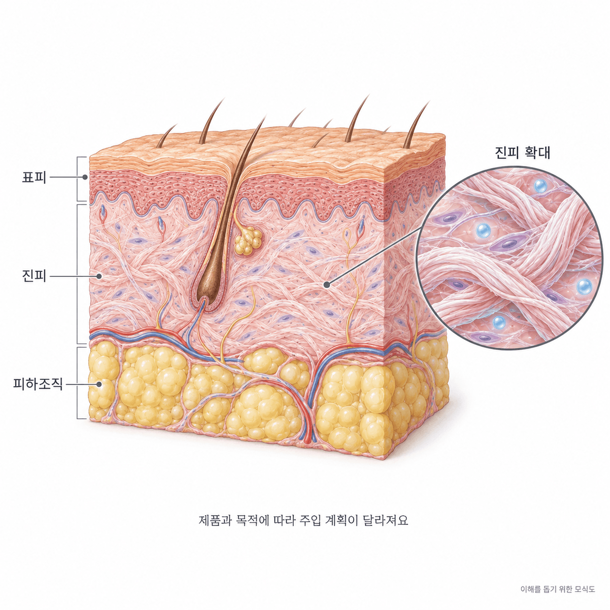표피·진피·피하조직과 진피 확대 모식도. 제품과 목적에 따라 주입 계획이 달라져요.