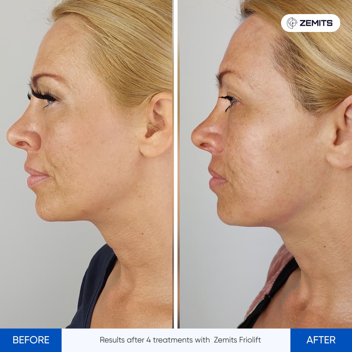 Before and after neck treatment by Zemits Friolift