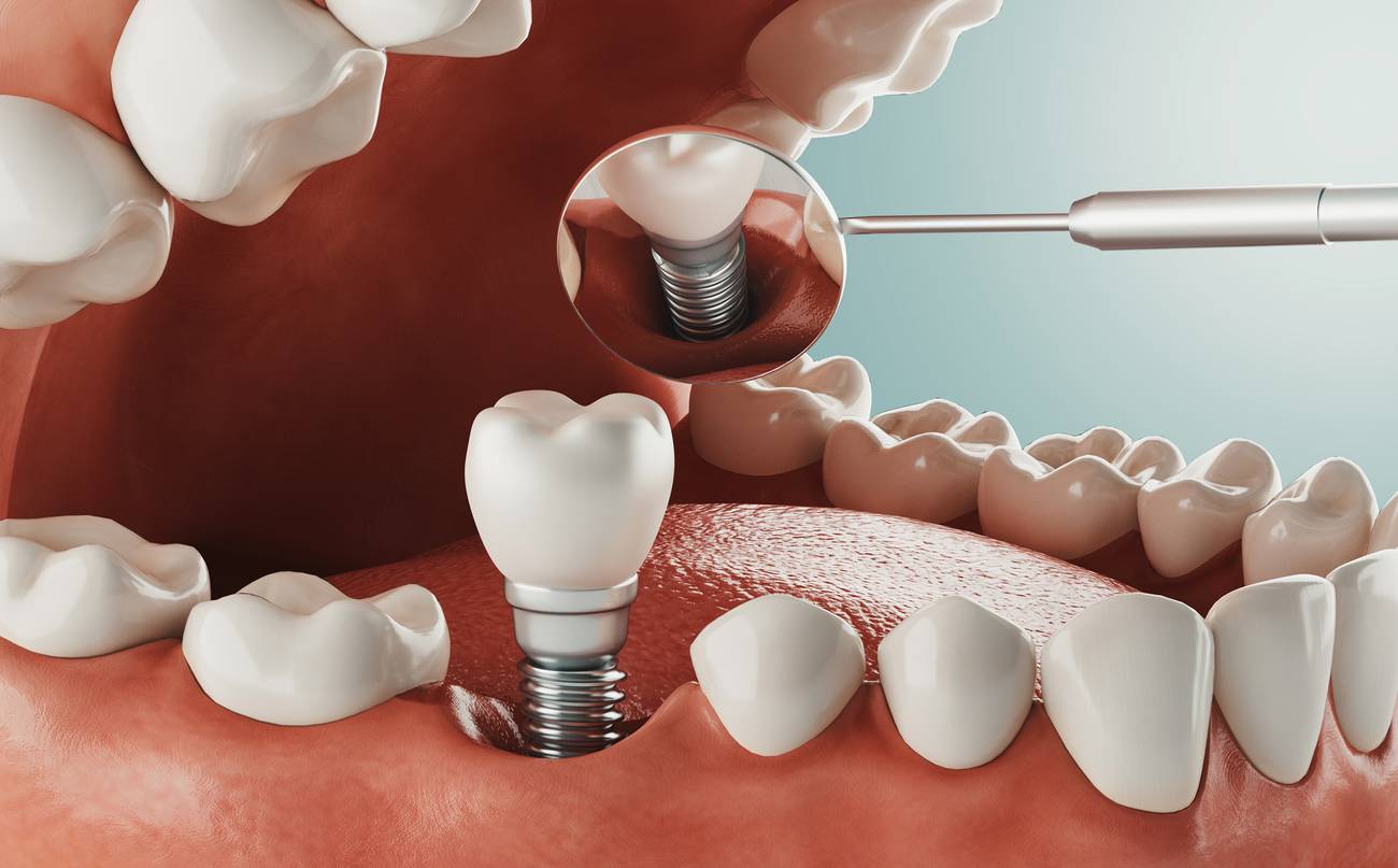 dental implants long island