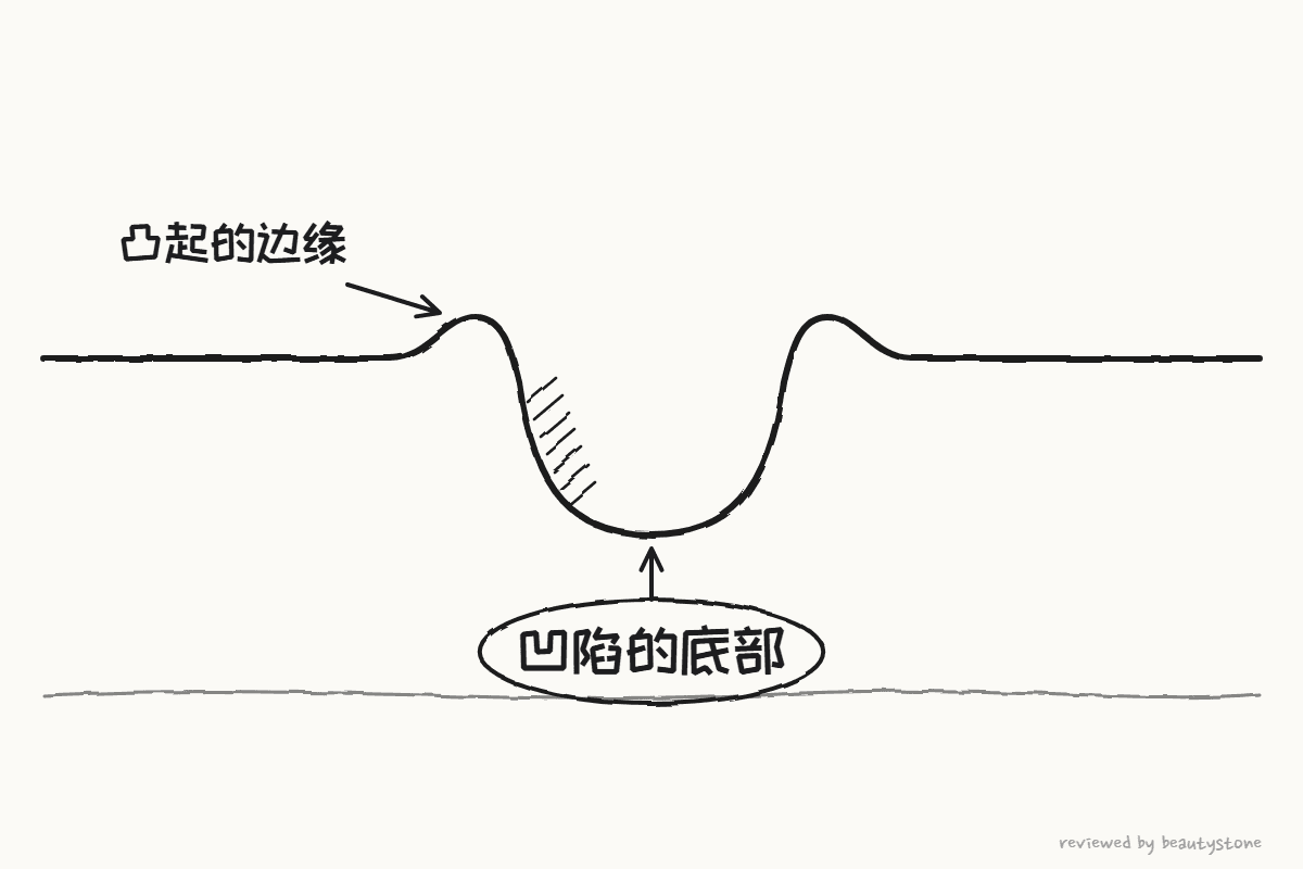 用钢笔画的疤痕截面图:底部凹陷