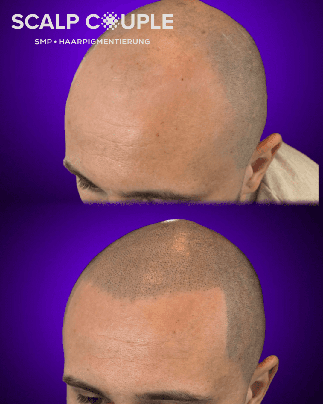 Haarpigmentierung Mann Glatze Vorher Nachher – SMP Ergebnis | Scalp Couple