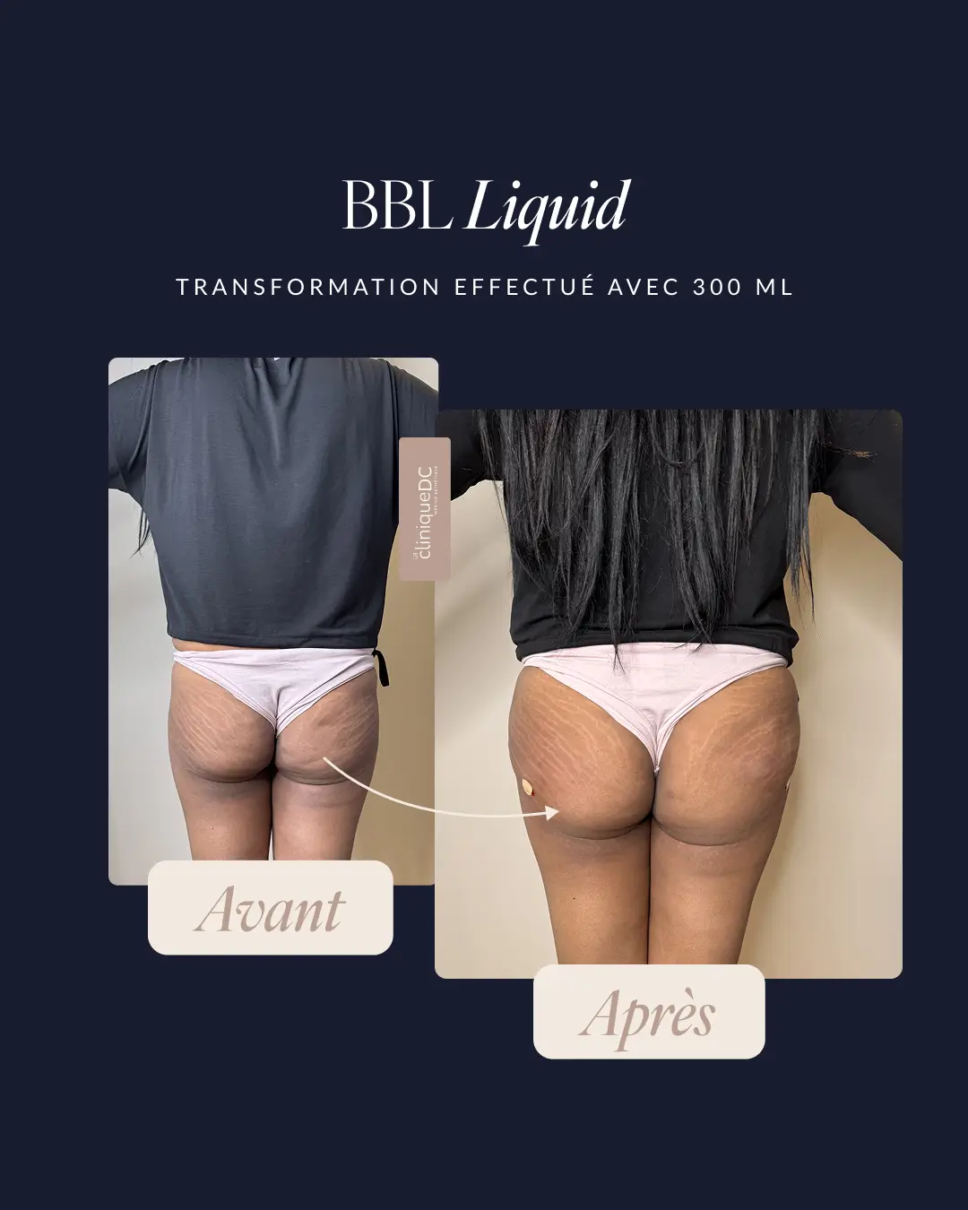 avant-après epilation laser visage joues