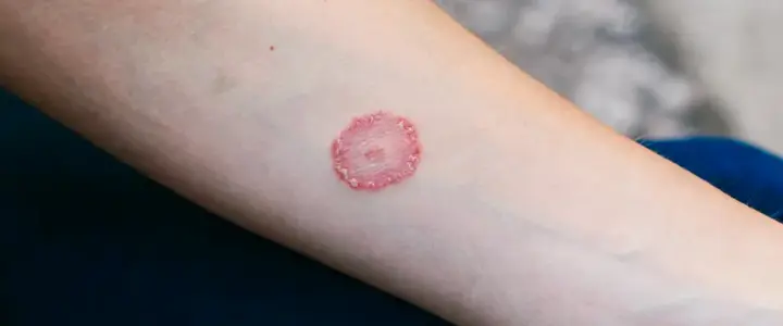 Coin-shaped or oval patches on trunk, arms, or legs