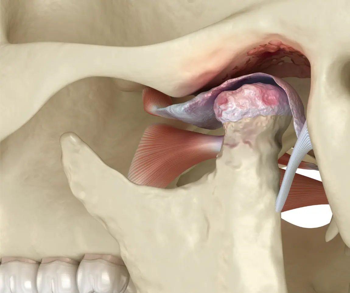Arthritic TMJ
