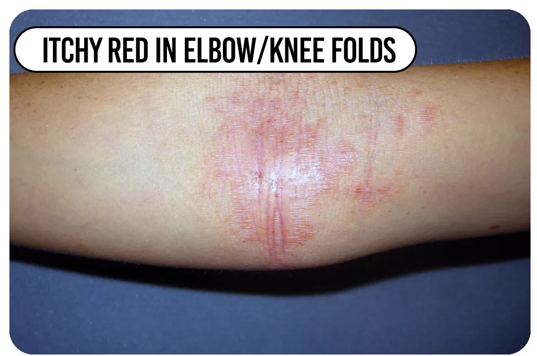 Itchy red in elbow/knee folds
