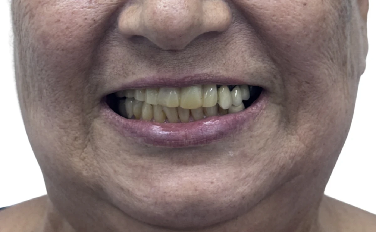 Paciente de Distrito Dental antes de hacerse un implante dental