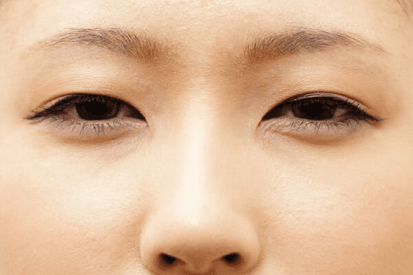 Nhấn mí lại khi mắt bị sụp nhẹ khiến gương mặt thiếu tươi tắn